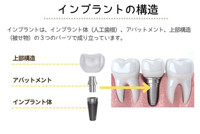 インプラントの構造